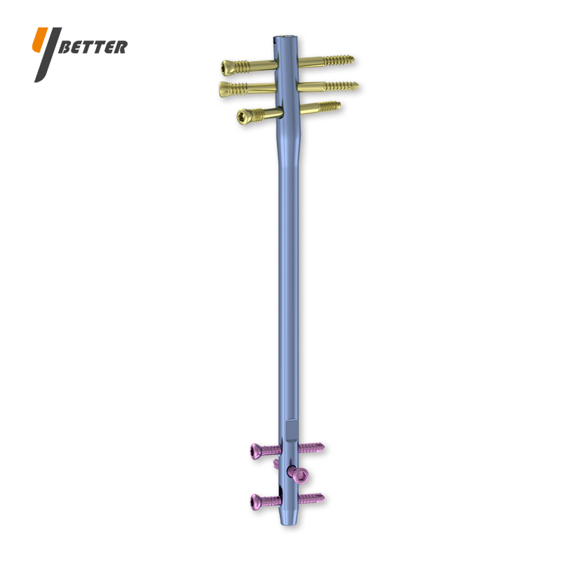 股骨倒打髓內(nèi)釘