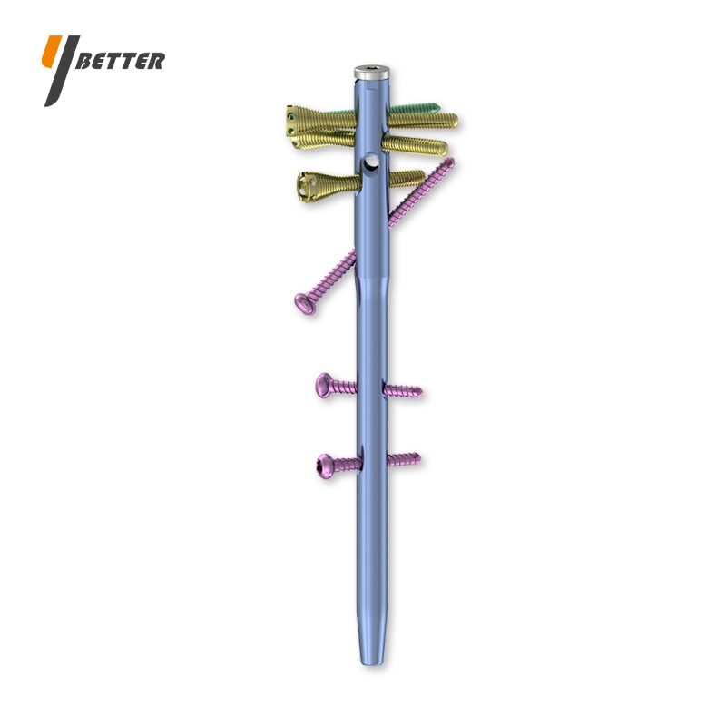 多維鎖定肱骨髓內(nèi)釘