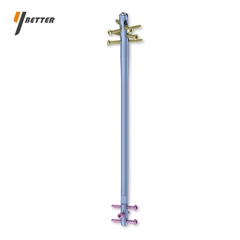 鎖定型脛骨髓內(nèi)釘