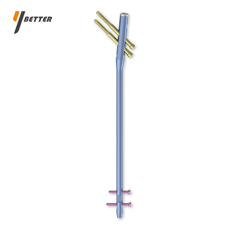 股骨帶鎖髓內(nèi)釘（3合1）