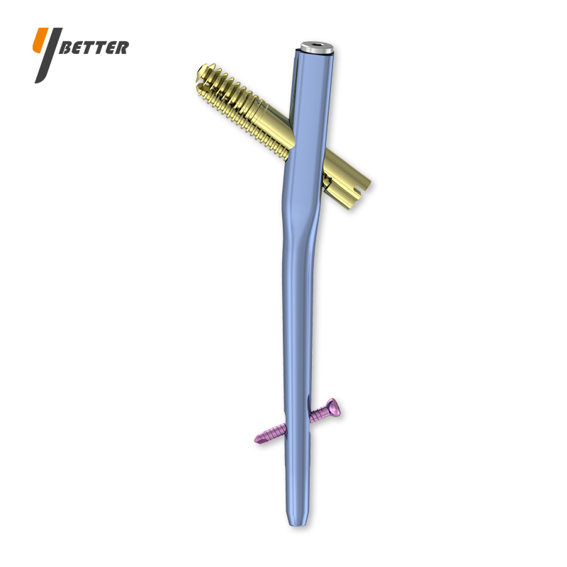 股骨近端可控加壓髓內(nèi)釘