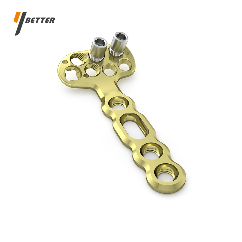 Y-DVR橈骨遠(yuǎn)端掌側(cè)接骨板